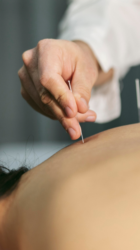 Acupuntura